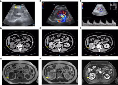 Case report: A collision tumor of clear cell renal cell carcinoma and clear cell papillary renal cell tumor